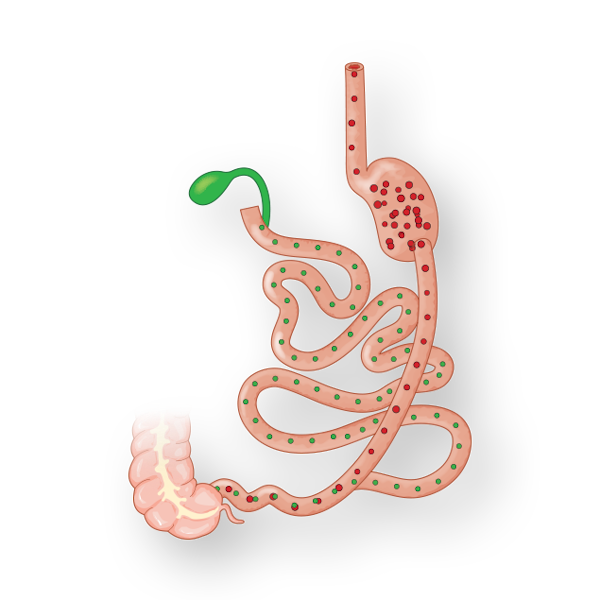 Diagram of Duodenal Switch
