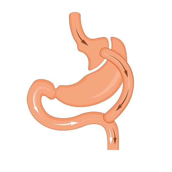 gastric bypass illustration