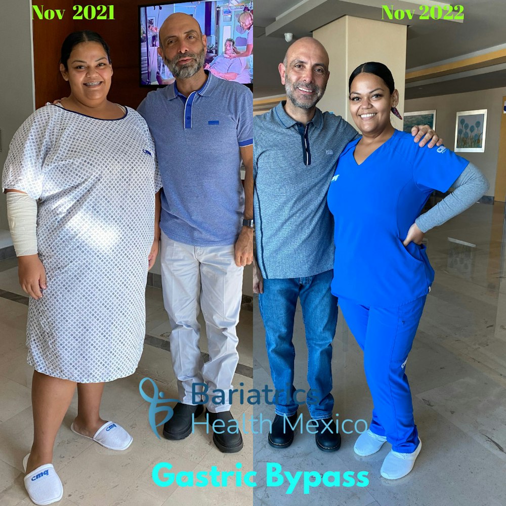 Doctor with patient before and one year after bariatric surgery