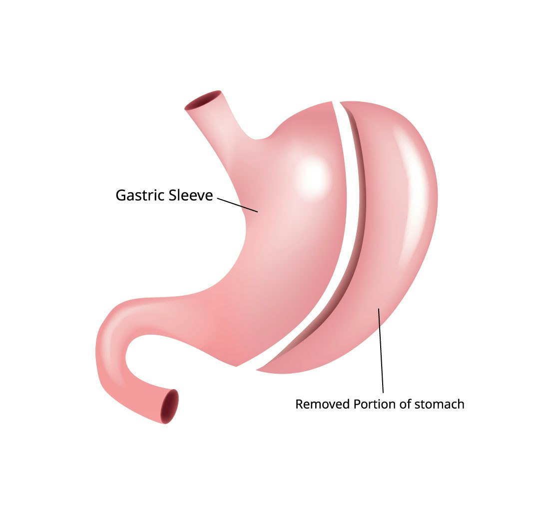 Gastric sleeve surgery